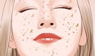 激光祛斑后注意事项（激光祛斑后注意哪些事项）