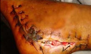 伤口不愈合怎么办（伤口不愈合怎么办能快速好起来）