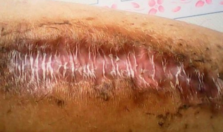 伤口化脓怎么办 伤口化脓用什么药效果最好