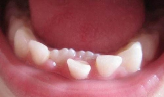 乳牙滞留怎么办 乳牙蛀牙只剩下残根怎么办