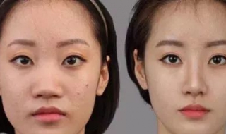 鼻翼大怎么办（鼻翼怎么样算大）