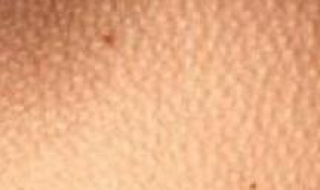 鸡皮皮肤怎么办（鸡皮皮肤怎么办才能变白）