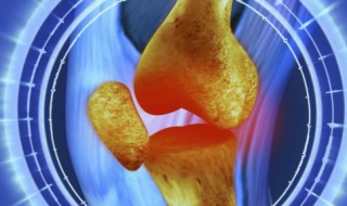 骨质增生怎么办（女性腰椎骨质增生怎么办）