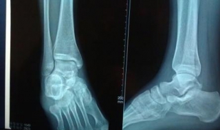 骨裂怎么办 骨裂一般多少天恢复