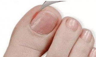 脚趾甲长到肉里怎么办（甲沟炎自己怎么处理好）