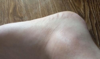 脚踝扭伤肿了怎么办 扭伤脚踝怎么消肿止痛