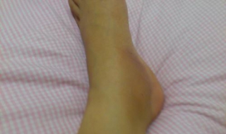 脚踝扭伤怎么办（脚踝扭伤怎么办恢复快）