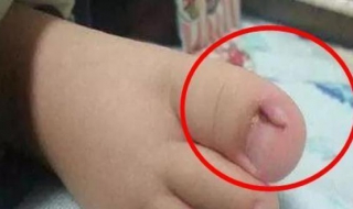 脚趾甲长肉里怎么办（大脚趾指甲边缘一按就疼）