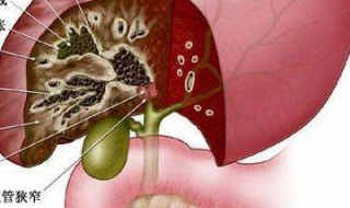 肝内胆管结石怎么办 胆切除后肝内胆管结石怎么办