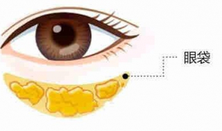 眼袋怎么办 眼袋怎么办才能消