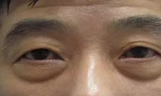 眼部皮肤松弛怎么办（眼周皮肤松弛怎么改善）