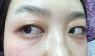 眼部松弛怎么办 眼部皮肤松弛怎么处理