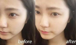 眼部细纹怎么办 眼细纹严重怎么办