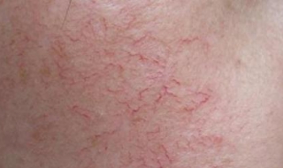 满脸红血丝怎么办（脸全是红血丝该怎么办）