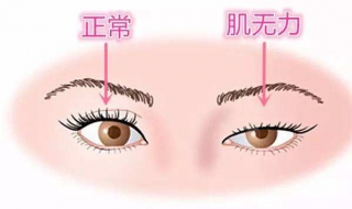 上眼睑下垂怎么办（上眼皮松弛下垂最好解决方法）