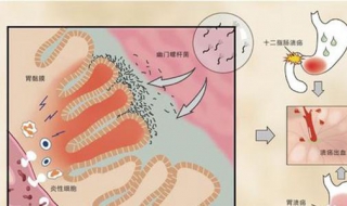 胃镜检查后注意事项（胃镜检查前注意事项）