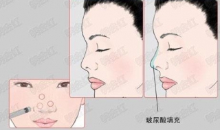 怎样注意玻尿酸隆鼻后注意事项 怎样注意玻尿酸隆鼻后注意事项视频