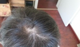 掉头发很厉害怎么办（毛囊检测需要多少钱）