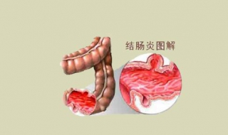 得了结肠炎怎么办 慢性结肠炎的症状及治疗
