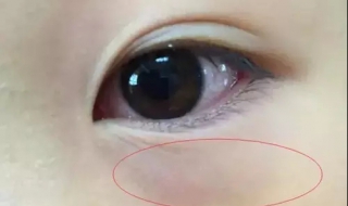 小孩有黑眼圈怎么办（小孩子黑眼圈重是什么原因造成的）