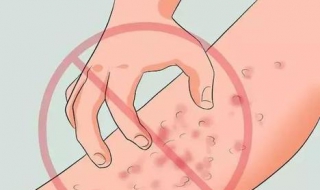 小孩长痱子怎么办 婴儿长痱子怎么快速消除