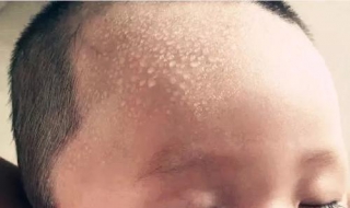 宝宝盗汗怎么办 小孩出盗汗是什么原因造成的