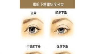 下眼皮下垂怎么办 下眼皮下垂怎么办可以恢复吗