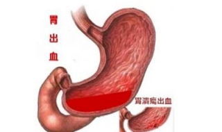 胃出血吃什么好 胃出血吃什么好得快