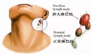 颈部淋巴结肿大怎么办（腋窝和颈部淋巴结肿大怎么办）
