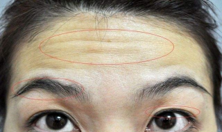 抬头纹很重怎么办 额头抬头纹很重怎么办