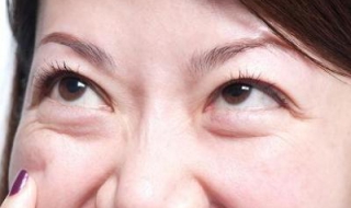有眼袋该怎么办 眼袋该怎么办才能消除