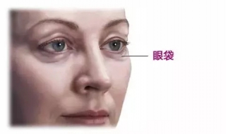 下眼袋浮肿怎么办（下眼袋浮肿怎么办能消除）