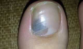 灰指甲怎么办 得了灰指甲怎么办