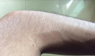 汗毛重怎么办 脸上汗毛重怎么办