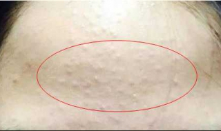 毛囊角质化怎么办（毛囊角质化怎么彻底治疗）