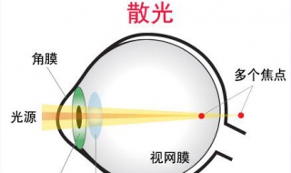 散光怎么办 散光怎么办能恢复吗