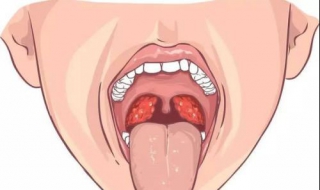 扁桃体炎怎么办（急性扁桃体炎怎么办）