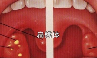 扁桃体发炎怎么办（扁桃体发炎怎么办最简单的方法）