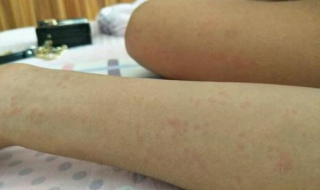 慢性荨麻疹怎么办（得了慢性荨麻疹怎么办）