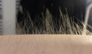 雄性激素分泌过多怎么办（女性雄性激素分泌过多怎么办）