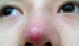 隆鼻失败怎么办（隆鼻失败怎么维护自己权益）