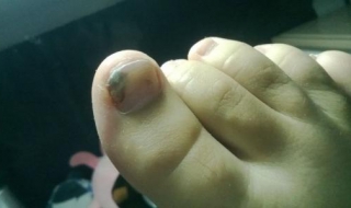 脚趾甲灰指甲怎么办 脚趾甲灰指甲怎么办推荐亮甲效果好