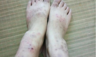 皮肤湿疹怎么办（得了皮肤湿疹怎么办）