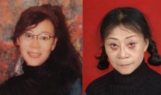 眼袋手术失败怎么办 眼袋手术 失败