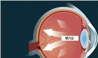 眼压高怎么办 眼睛眼压高怎么办