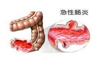 急性肠胃炎及时发现并治疗（急性肠胃炎及时发现并治疗的原因）