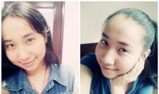 额头高头发少怎么办（额头高头发少怎么办女）