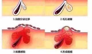 怎么有效治疗痤疮 怎么有效治疗痤疮图片