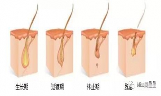 激光脱毛注意事项（激光脱毛后的注意事项）