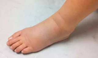 小腿浮肿怎么办（长期坐着小腿浮肿怎么办）